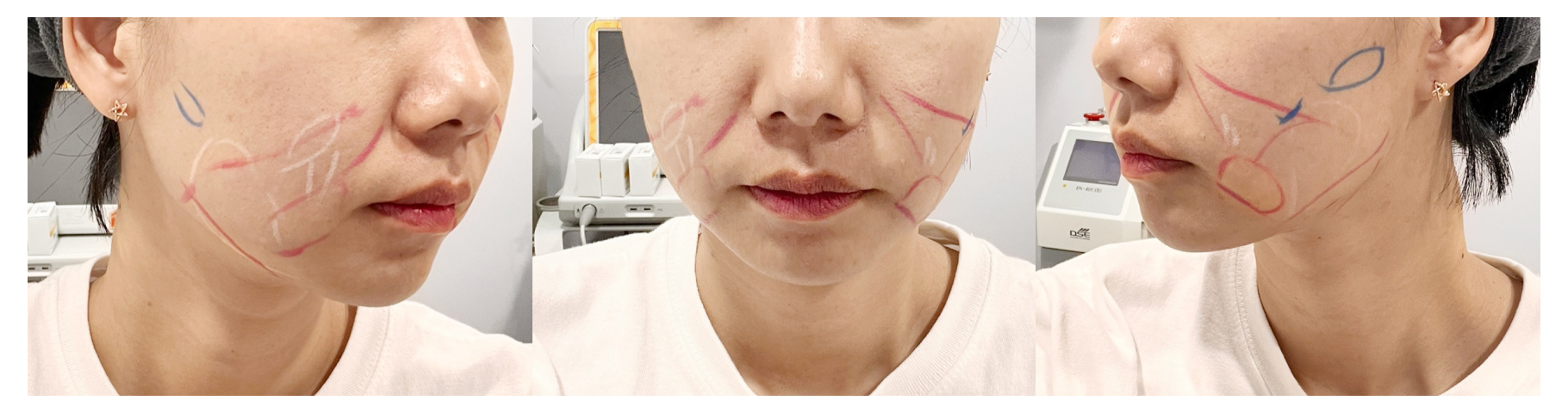 인모드 압구정 유진스의원, 맞춤형 인모드 시술 디자인 사례 1