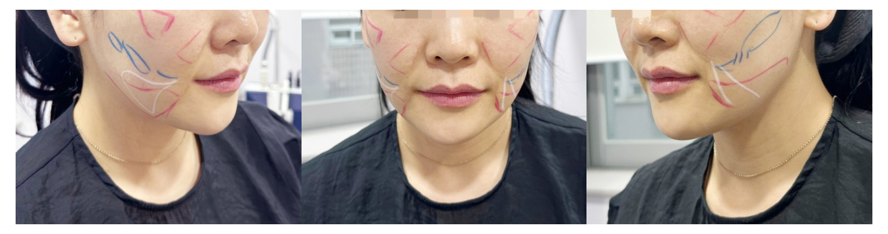 인모드 압구정 유진스의원, 맞춤형 인모드 시술 디자인 사례 2