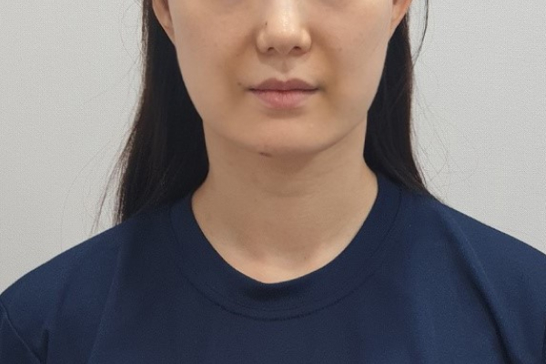 온다티타늄 압구정 유진스의원, 유진스 온타늄 시술 후기 2