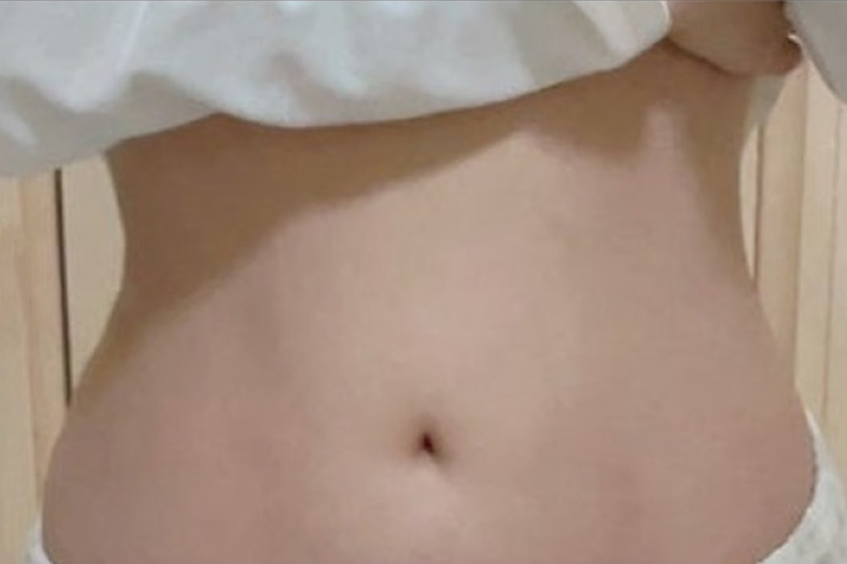 뉴핏주사 압구정 유진스의원, 뉴핏주사 시술 후기 3