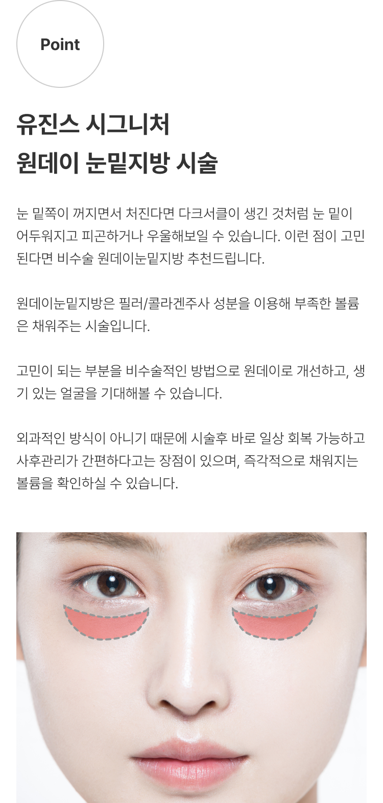 원데이 눈밑지방 압구정 유진스의원, 유진스 시그니처 원데이 눈밑지방 시술 - 꺼진 눈밑 볼륨과 다크서클을 비수술 방식으로 개선하는 시술